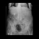 Casting renal stones, KUB radiograph: X-ray - Plain radiograph